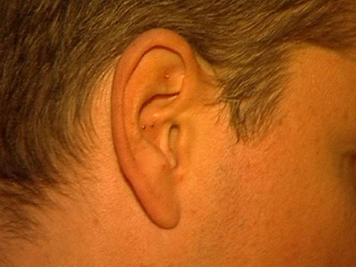 Matt Damons Ohr mit Akupunktur-Nadeln 